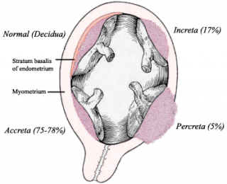 Illustration of placentas (and truncated umbilical cords), showing the difference between normal and abnormal placental implantation with differing degrees of accreta; look at the light red areas where the placenta touches the uterus to see the difference Image from Wikimedia Commons