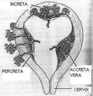 placenta-accreta-koneijeti-2009-rev-urol